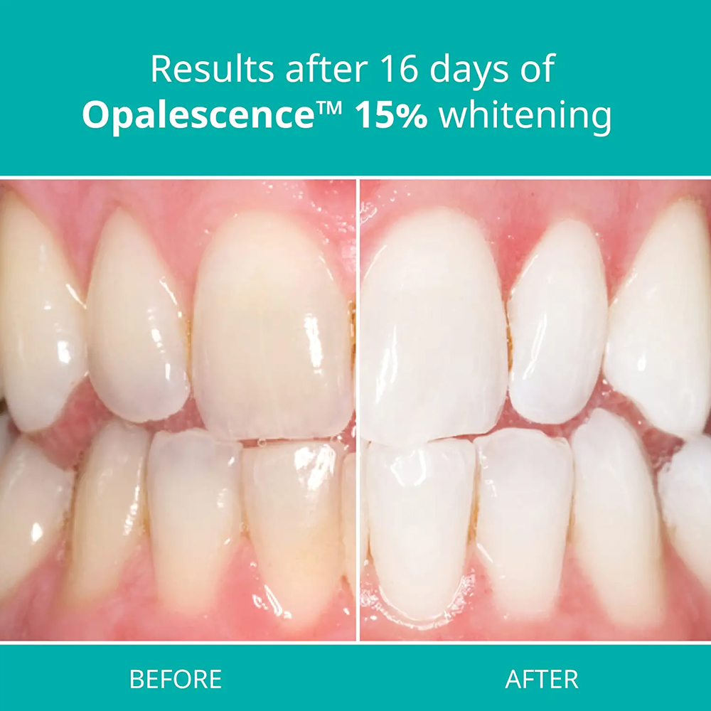 Kit de blanchiment professionn - Teeth Whitening Gel Refills avis et prix