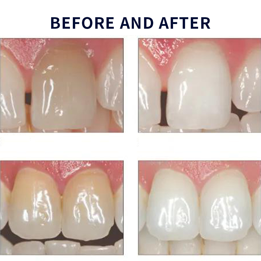 Opalwisdom-Kit de Blanchiment  - Teeth Whitening Before And After avis et prix