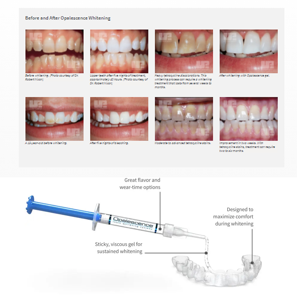 Opalwisdom-Kit de Blanchiment  - Teeth Whitening Before And After avis et prix