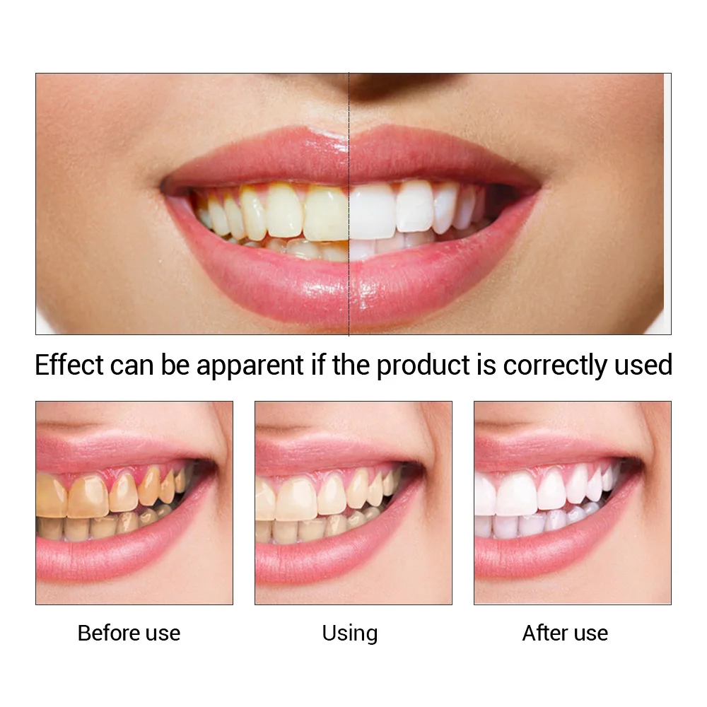 FTEENPLY poudre d'essence de b - Teeth Whitening (Bleaching) avis et prix